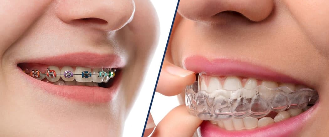 Orthodontic treatment showing braces or clear aligners