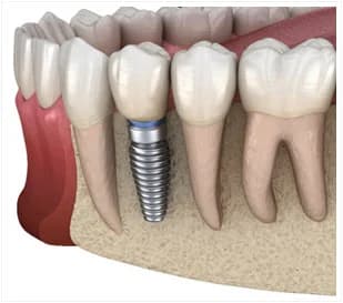 Dental implant model and consultation context