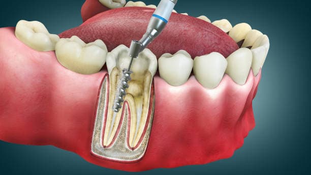 Dentist performing a root canal treatment with precision tools