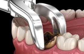 Tooth extraction setup in a sterile dental treatment room